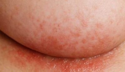 What to Do Today if You Have an Itchy Rash Under Your Breasts in Winter