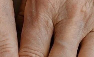 Why Veins Become More Noticeable with Age