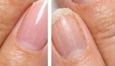 Soak your nails in this 1 mixture and get rid of brittleness, vertical ridges, and peeling edges