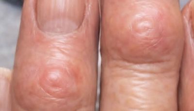 Hard Bumps on Finger Joints Near the Nails: What They Could Mean