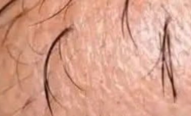 Surprising Truth About Chin Whiskers in Women