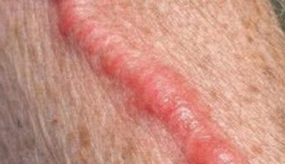 My grandfather woke up with this swollen red cord like vein on his arm