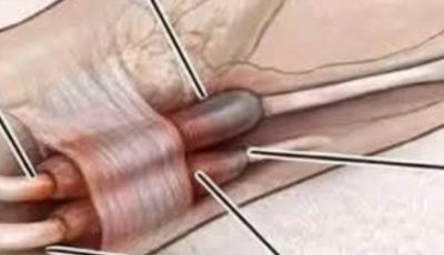 Why Do Your Hands Fall Asleep? Common Causes and Natural Remedies That Actually Work
