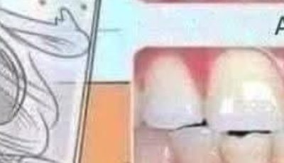 Whitening Teeth Naturally with Bay Leaves and Cloves A Dental Tip