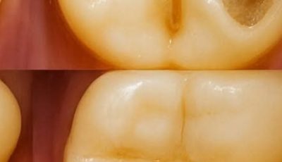 Tired of Cavities? Try These Natural Tips for Stronger, Healthier Teeth