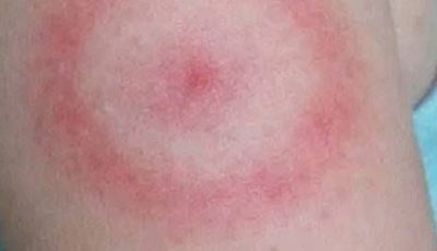 My daughter woke up with this strange red ring on her arm. It’s not itchy but looks spreading. I’m panicking, do I need to rush her in?